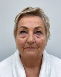 Круговая блефаропластика - до