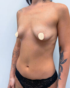 Маммопластика увеличение - до