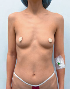 Маммопластика увеличение - до