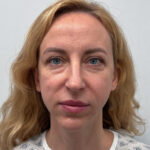 Блефаропластика и эндоскопический лифтинг - до