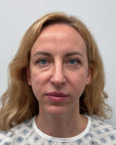 Блефаропластика и эндоскопический лифтинг - до