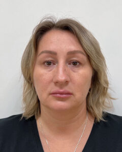 Блефаропластика и эндоскопический лифтинг - до