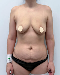 Абдоминопластика - до