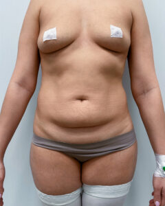 Абдоминопластика - до