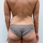 Липосакция - до