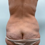 Липосакция с абдоминопластикой - до