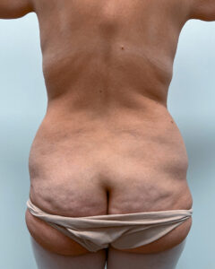 Липосакция с абдоминопластикой - до