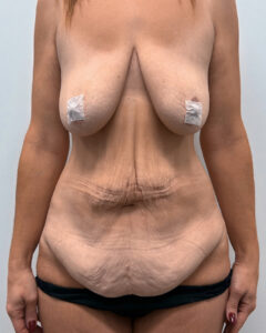 Абдоминопластика - до