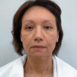 СМАС лифтинг - до