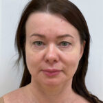 СМАС лифтинг - до