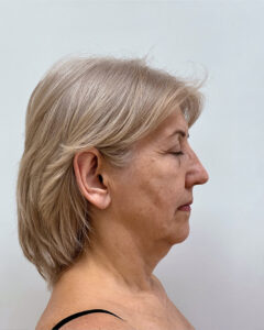 СМАС лифтинг - до