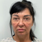 Тотальное омоложение - до