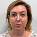 Блефаропластика и эндоскопический лифтинг - до