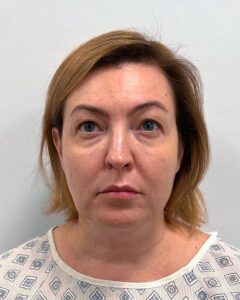 Блефаропластика и эндоскопический лифтинг - до