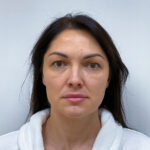 Блефаропластика и эндоскопический лифтинг - до