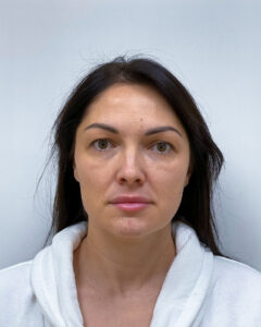 Блефаропластика и эндоскопический лифтинг - до