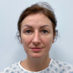 Верхняя блефаропластика с эндоскопическим лифтингом - до