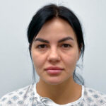 Круговая блефаропластика с эндоскопическим лифтингом - до