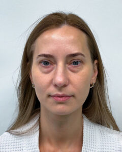 Трансконъюнктивальная блефаропластика - до