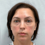 Трансконъюнктивальная блефаропластика - до