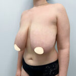 Редукционная маммопластика - до