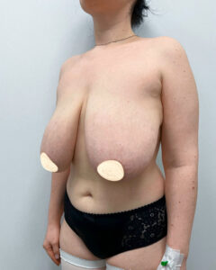 Редукционная маммопластика - до