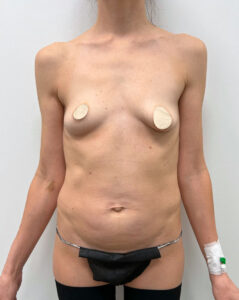 Маммопластика подтяжка - до