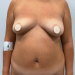 Маммопластика подтяжка в сочетании с пластикой живота - до