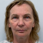 Тотальное омоложение лица - до