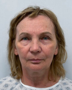 Тотальное омоложение лица - до