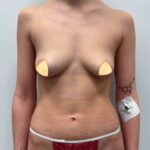 Маммопластика увеличение - до