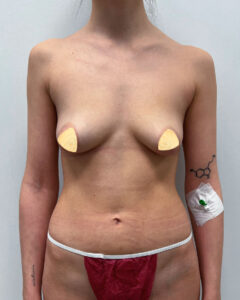 Маммопластика увеличение - до