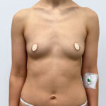 Маммопластика увеличение - до