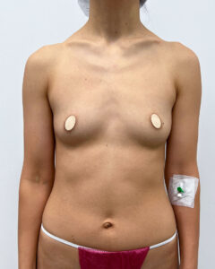 Маммопластика увеличение - до