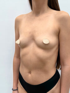 Маммопластика увеличение - до