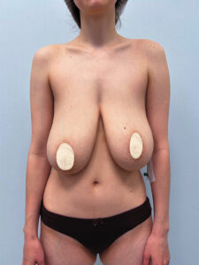 Редукционная маммопластика - до