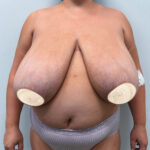 Редукционная маммопластика - до