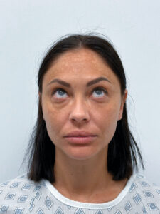 Нижняя блефаропластика - до