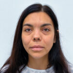 Нижняя блефаропластика - до