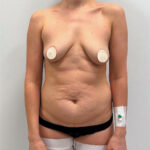 Подтяжка + бодилифт - до