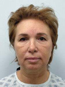 Тотальное омоложение лица - до