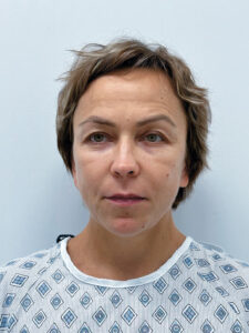 Эндоскопический лифтинг в сочетании с блефаропластикой - до