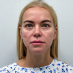 Периорбитальная эндоскопическая бьютификация - до