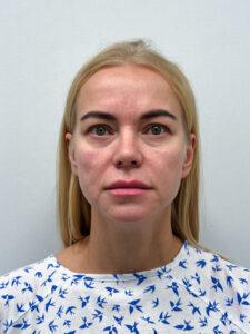 Периорбитальная эндоскопическая бьютификация - до