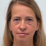 Эндоскопический лифтинг с блефаропластикой - до