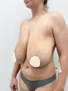 Редукционная маммопластика - до