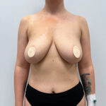 Подтяжка - до