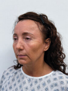 Тотальное омоложение лица - до