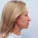 Тотальное омоложение лица - до