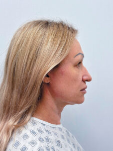 Тотальное омоложение лица - до